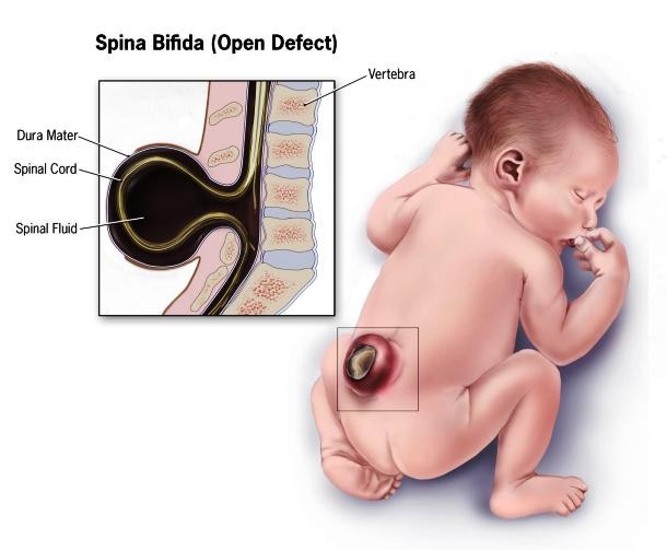 espinha bifida