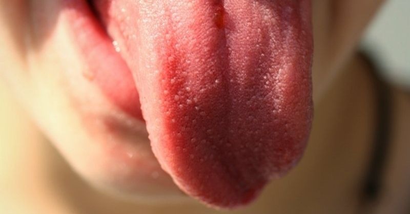língua peluda-capa